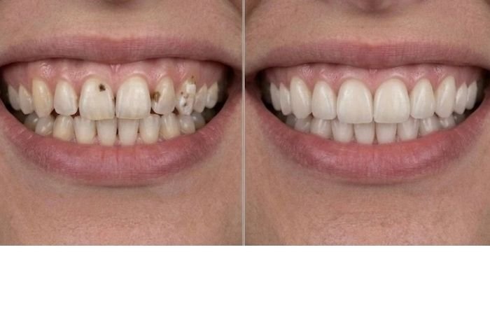 Before and after picture of how good fillings can look instead of doing crowns and removing so much tooth structure