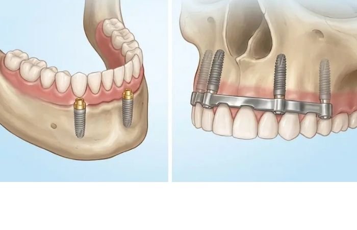 Upper and lower implant retained dentures